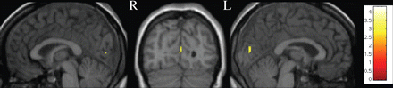 Voxel-by-voxel whole brain GM MTR maps comparison between CIS patients with optic neuritis (n = 80) and controls (n = 50) (two-sample t-test, amplitude threshold P < 0.001). Results are displayed on a normalized T1 scan. MTR decrease in patients is observed bilaterally in the visual cortex (BA 17).
