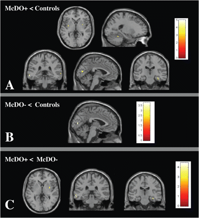 Voxel-by-voxel whole brain GM MTR maps comparison between CIS patients fulfilling McDonald's criteria (n = 20) and controls (n = 50) (A), CIS patients not fulfilling McDonald's criteria (n = 60) and controls (n = 50) (B), CIS patients fulfilling McDonald's criteria (n = 20) and CIS patients not fulfilling McDonald's criteria (n = 60) (C) (ANOVA analysis, amplitude threshold P < 0.001). A: MTR decreases are located in the bilateral visual cortex (BA 17/18), the bilateral lenticular nuclei, the bilateral superior temporal cortex (BA 21), the right cerebellum and the left hippocampus. B: MTR decreases are located in the bilateral visual cortex (BA 17). C: MTR decreases are located in the left lenticular nucleus, the right superior temporal cortex (BA 21) and the left hippocampus.