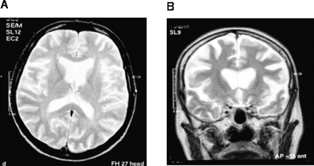 Brain MRI of a 40-year-old woman with an 18-month history of a progressive behavioral, language and cognitive disorder (individual IV:1). (A) Axial T2-weighted image showing symmetrical widening of the frontal lobe sulci, sylvian fissures and anterior horns of the lateral ventricles with relative sparing of the posterior cerebrum. (B) Coronal T2-weighted image showing striking frontal lobe atrophy and an absence of signal change in the white matter of both hemispheres.