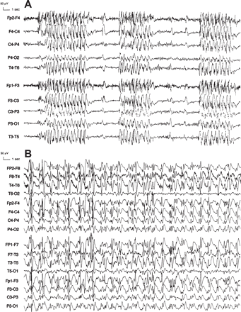 Typical and atypical ASE in JAE. (A) This 15-year-old girl (Patient 2) with JAE was treated with PB, 100 mg/day, and VPA, 1000 mg/day. Weight gain and an erroneous syndromic classification of CPE of frontal origin led to the replacement of VPA by CBZ, 600 mg/day. When CBZ was raised to 800 mg/day, typical ASE developed, characterized by serial bursts of 3 Hz generalized polyspike-and-wave complexes, recurring every 5–10 s. Mild impairment of consciousness and eyelid myoclonia were prominent during discharges. (B) This 39-year-old woman (Patient 3) with JAE had long-standing aggravation on CBZ, 800 mg/day, PHT, 350 mg/day, and PB, 50 mg/day. Shortly after awakening, she very often had episodes of prolonged cognitive impairment of varying intensity, one of which led to a car accident. During a 5-day video-EEG monitoring, a 180 min atypical ASE was recorded, with severe confusion, inappropriate familiarity, sexual disinhibition and a peculiar compulsive rhythmic stereotyped movement of flexion-extension of the right arm. EEG shows continuous, diffuse, irregular, high-amplitude, 1 Hz polyspike-and-slow wave and spike–and-wave activity with slight right-sided predominance.
