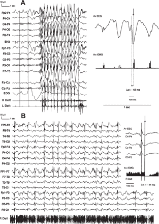 Positive and negative MSE as an effect of CBZ. (A). This 18-year-old man (Patient 10) with JME received CBZ, 800 mg/day, from the onset and had since experienced numerous episodes of MSE lasting up to 30 min after awakening. EEG shows very frequent 10–20 s bursts of generalized, rhythmic polyspike-and-slow wave complexes (PSW) at 3 Hz, synchronous with the myoclonia. Jerk-locked back-averaging of 30 traces shows that the last spike component precedes the onset of the myoclonic jerk with a 48 ms delay. (B) This 17-year-old man (Patient 11) with CAE was poorly controlled on VPA, 1000 mg/day, and PHT, 300 mg/day. Prolonged episodes of unsteady gait and clumsiness, related to negative MSE, occurred shortly after CBZ was added. EEG shows continuous 1–2 Hz PSW with a frontal predominance synchronous with the atonia. The EMG shows that interruption of tonic muscular activity occurs without evidence of an antecedent positive myoclonic jerk. Silent period-locked back-averaging of 50 consecutive traces shows a 44 ms delay between the peak of the last spike and the onset of atonia. R Delt: right deltoid; L Delt: left deltoid; Av EEG: averaged EEG; AV rEMG: averaged rectified EMG; Lat: latency.