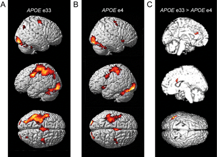 Main effects for categorization versus baseline in (A) APOE ε3/3 carriers (n = 30) and in (B) APOE ε4 carriers (n = 30). There is an apparent difference between groups in left parietal cortex that was confirmed in the group contrast depicted in (C). Additionally, in the group comparison, differences were seen in the anterior cingulate region, bilaterally.