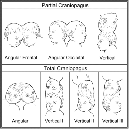 Classification of craniopagus. ‘Partial’ and ‘Total’ forms of the craniopagus malformation.