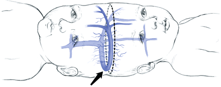The CVS (arrow) is typically contained within the peripheral dural shelf of one child, but drains the homolateral hemisphere of each child. The dural shelf is usually in continuity with an incomplete or complete layer of dura separating the twins' hemispheres. Surgical separation strategy may entail sequential division of venous sinus branches from the right twin (dashed line), allowing the anatomically predisposed left twin to keep the major CVS and associated dura. In the right twin, subsequent reversal of venous drainage to collateral basal channels may be induced.