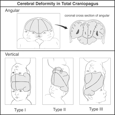 Cerebral deformity in total craniopagus. Angular and vertical Types I, II and III.