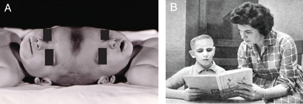 (A) The Brodie twins separated in 1952. (B) Rodney Brodie at age 10 being home schooled. (Photographs provided by Dr Herbert J. Grossman, with permission).