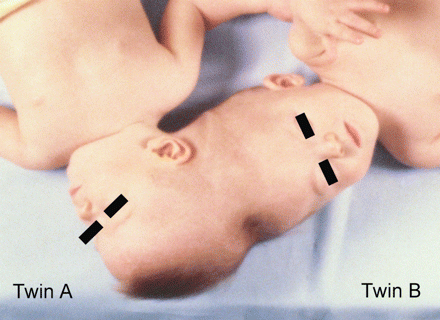 Total angular asymmetric twins treated at the University of Illinois in Chicago in 1981 (Photograph from the author's collection, J.L. Stone).