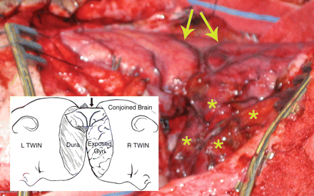 Total vertical Type I twins, prone position, near conclusion of the final surgical separation stage. As in Fig. 2, the left twin was predisposed to retain the major superior venous drainage (CVS) including the incomplete transverse dural septum between the hemispheres. A retractor spreads the cleavage plane between hemispheres, and the circular defect in the dural septum was incised to further inspect the 3 cm diameter segment of conjoined parietal cortex with enclosed white matter before division. Arrows point to homologous diverging veins at the site of cortical fusion, and asterisks indicate exposed flattened superior gyri of the right twin (Photograph from the author's collection, J.L. Stone and J.T. Goodrich).