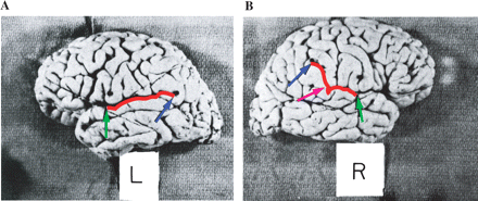 (A) Illustration of the left PT. Sagittal view of a post-mortem brain. The horizontal portion (from the green to the blue arrow) of the left PT is found to be longer than the right PT (seen in B from the green to the pink arrow). (B) Illustration of the right PT. Sagittal view of a post-mortem brain. The pink arrow points out the posterior ending of the horizontal portion (also referred to as the bottom end-point of the posterior ascending ramus) of the SF and PT, whereas the blue arrow points to the actual ending of the PT. The region between the pink and blue arrows has been traditionally excluded from PT measurements, as this region was believed to pertain to the PP or the posterior ascending ramus. Overall the right PT (from the green to the blue arrow) curves more anteriorly and extends more vertically than the left PT (seen in A) Original illustrations A and B reproduced with permission from Rubens AB, Mahowald MW, Hutton JT. Asymmetry of the lateral (sylvian) fissures in man. Neurology 1976; 26: 620–4.