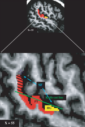 Illustration of how the knife-cut method was implemented on an MRI scan. Sagittal view of the labelled volume in the right hemisphere. A projection line (knife-cut line) mimicking the knife trajectory along the SF was imagined and the labels falling above that line (blue dash lines) were removed. PT = planum temporale; HG = Heschl's gyrus; SF = sylvian fissure.