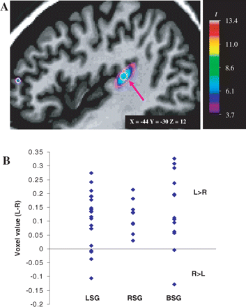 (A) Sagittal view of the left hemisphere. Voxel-based morphometric statistical map averaged across the three speech groups superimposed on the MRI scan of a single subject. A statistical peak in the region of the PT is shown here (arrow), which reveals an interhemispheric asymmetry in grey-matter concentration in the PT across all three speech groups. (B) Distribution of the voxel values extracted at the statistical peak corresponding to the Talairach coordinates of the PT (−44, −30, 12) for the three speech groups. L > R = more grey-matter concentration in the left hemisphere; R > L = more grey-matter concentration in the right hemisphere. Other abbreviations as in Fig. 4.