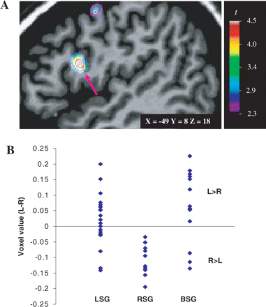 (A) Sagittal view of the left hemisphere. Voxel-based morphometric statistical difference map contrasting the two speech groups, LSG and RSG, superimposed on the MRI scan of a single subject. A statistical peak in the pars opercularis, functionally known as Broca's area, is shown here (arrow), and it reveals an interhemispheric asymmetry where LSG had more grey matter in the left hemisphere than RSG. (B) Distribution of the voxel values extracted at the statistical peak corresponding to the Talairach coordinates of the pars opercularis (−49, 8, 18) for the three speech groups. L > R = more grey-matter concentration in the left hemisphere; R > L = more grey-matter concentration in the right hemisphere. Other abbreviations as in Fig. 4.