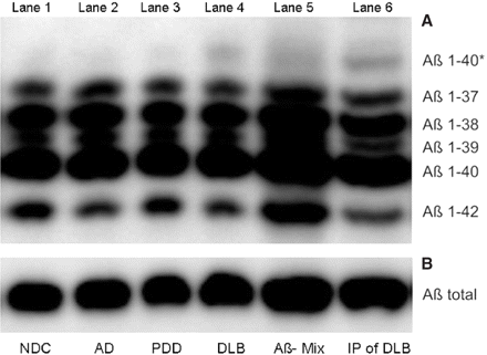Urea-based Aβ-SDS–PAGE/immunoblot (A) and conventional SDS–PAGE (B) of CSF (lane 1–4,6) and synthetic Aβ-peptides 1–37, 1–38, 1–39, 1–40, 1–42 (lane 5). Ten microlitres of an unconcentrated CSF pool of seven NDC (lane 1), Alzheimer's disease (lane 2), PDD (lane 3) and DLB (lane 4) patients were applied. 1E8 immunoprecipitated CSF pool of seven DLB patients was applied to lane 6. Quantifications have been obtained from individual blots of each patient.