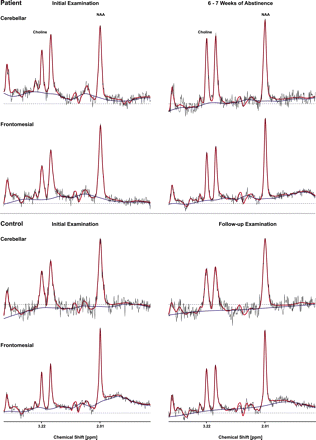 Representative cerebellar and frontomesial MR 1H-spectra (TR = 1500 ms/TE = 135 ms, PRESS) of a patient selected from our sample (n = 15) of uncomplicated alcoholics upon short-term abstinence and of a healthy control subject upon follow-up (red: LCModel fit, blue: baseline; displayed range: 1.00–4.00 p.p.m.).