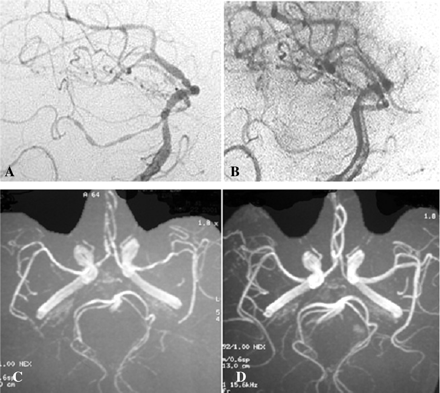 Vascular imaging in RCVS. (A) Catheter angiography at disease onset: multiple narrowing and dilatations, (B) Control catheter angiography at 3 months, (C) MRA at disease onset and (D) Control MRA.