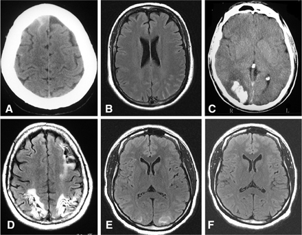 Brain imaging in RCVS. (A) CT scan showing a small cSAH, (B) MRI (FLAIR sequence) showing a small cSAH, (C) CT scan showing an occipital intracerebral haemorrhage, (D) MRI showing sequelae of bilateral occipital infarcts and left frontal-parietal infarct, (E) MRI (FLAIR) showing hypersignals consistent with a RPLS and (F) Control MRI in the same patient after 28 days showing resolution of the RPLS.