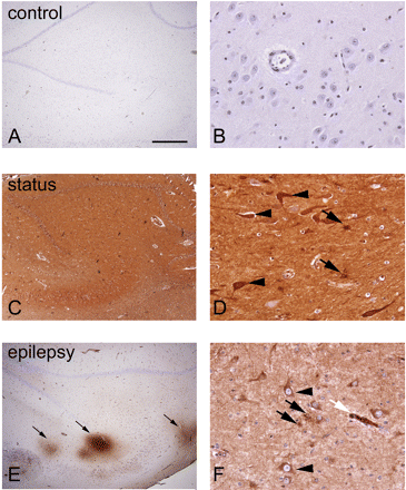 Albumin immunocytochemistry in the human hippocampus. In autopsy control tissue (A and B) no albumin staining is present. Most albumin extravasation was observed in autopsy material of patients that died during SE. Very strong albumin IR was seen around all blood vessels within the hippocampus and cortex (C and D). In addition, many neurons (arrowheads in D) and astrocytes (arrows in D) were also highly immunoreactive. In resected hippocampi from temporal lobe epilepsy patients strong albumin IR was present in parenchyma throughout the hippocampus, next to blood vessels (arrows in E). Neurons (arrowheads in F) and astrocytes (black arrows in F) were also albumin positive. The white arrow in F shows a blood vessel with albumin extravasation. Scale bar A, C and E = 800 μm, B, D and F = 75 μm.