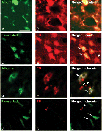 Colocalization of Albumin, Fluoro-Jade B and Evans Blue. Immunostainings with anti-albumin confirmed that EB containing cells also contained albumin, both in the acute period (1 day after SE; A–C) as well as in chronic epileptic rats (4 months after SE; arrows in I). However, not all EB particles colocalized with albumin in the chronic period (arrowheads in I). A large number of EB positive cells colocalized with Fluoro-Jade B in the acute period (arrows in F), indicating degeneration. However, some neurons contained EB, but no Fluoro-Jade B (arrowhead in F), which suggests that not all albumin containing cells die. In chronic epileptic rats most EB were found in the piriform cortex (arrowheads in L). These particles did not colocalize with Fluoro-Jade B (arrows in L). Scale bar = 20 μm.