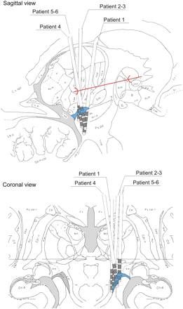Schematic representation of PPN-implantation sites. Sagittal (12 mm lateral to the mid-sagittal plane) and coronal (around PC) diagrams, from the Schaltenbrand atlas, illustrating the PPN functional region with respect to surrounding major structures. Shown are the targeted implantation locations in all patients of the study (n = 6). Note the substantial supra-imposition of trajectories for patients 2/3 and 5/6. The PPN-targeted region was emphasized in cyan. The solid red line in sagittal view corresponds to the AC–PC line. Given the actual size of the Medtronic 3389, the leads traverse the whole region including portions of ZI and partially bounds the lemniscus medialis.