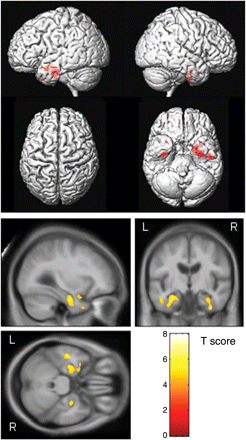 Patterns of grey matter atrophy in the aMCI progressors ∼3 years (18–54 months) before progression to AD. The results are shown on a 3D surface render (top) and overlaid on representative axial, coronal and sagittal slices (bottom). L = left; R = right.
