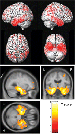 Patterns of grey matter atrophy in the aMCI progressors at the time of a diagnosis of AD. The results are shown on a 3D surface render (top) and overlaid on representative axial, coronal and sagittal slices (bottom). L = left; R = right.