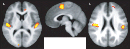 Reduced grey matter in patients in Heschl's gyri (left; z = 10), the SMA (middle; x = 4) and the parietal operculi (right; z = 22) obtained with the FSL-VBM approach overlaid on the average of the non-linearly registered T1-weighted images.
