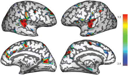 3D representation of the significant grey matter loss found in patients overlaid on an inflated cortical surface (FSL-VBM).
