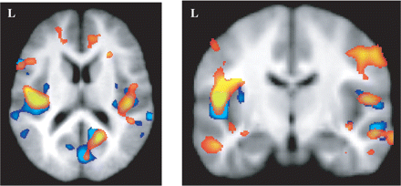 FSL-VBM results (red) and SPM-VBM results (blue) represented for the same range of t-values (>2.8). Results are very similar for instance in Brodmann area 44, the parietal operculi and the occipital lobe.