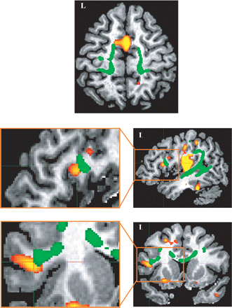 Examples demonstrating the correspondence between grey and white matter results: decrease of FA in the corticospinal/corticopontine tracts (green) and grey matter loss in the SMA (red) in the top row on an axial view; decrease of FA in the left arcuate fasciculus (green) and grey matter loss in Brodmann area 44 (red) in the middle row on a sagittal view and in the bottom row on a coronal view. Results were overlaid on a single control subject for a better identification of the regions involved.