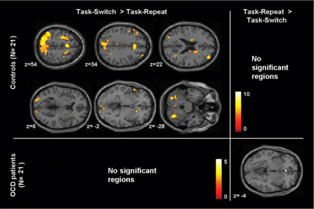 Increased activations associated with task-switch versus task-repeat contrast in the healthy controls and in the OCD patients. The activation is mapped on the MNI template (P<0.0001, uncorrected, k>20 voxels). Colour bars represent the T-value.