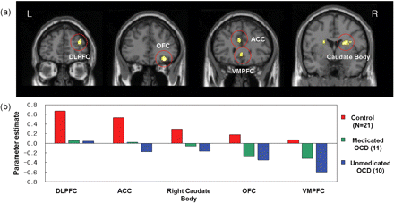 (A) The significantly different activation regions between the OCD patients and the healthy controls are mapped on the MNI template. P<0.001, uncorrected, k>20 voxels. DLPFC, dorsolateral prefrontal cortex; OFC, orbitofrontal cortex; ACC, anterior cingulate cortex; VMPFC, ventromedial prefrontal cortex. (B) Individual activation values of task-switch minus task-repeat in the ROI were extracted.