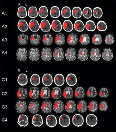 Individual patients’ lesions in the two groups represented in red. Patients A1–A4 formed the AHP group and Patient C1–C4 formed the Control HP group. All patients had lesions affecting the territory of the right middle cerebral artery.