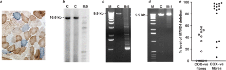 肌肉活检的组织化学和分子遗传学分析。（a） 患者II肌肉活检中COX和SDH联合活性的组织化学证明：5，显示约10%的COX缺乏纤维，一些显示异常线粒体的肌膜下堆积。（b）Southern blot和（c）肌肉DNA的长程PCR分析，显示患者II：5肌肉活检中存在多个mtDNA缺失。（d） 另一个受累家族成员（患者III:1）肌肉DNA的长程PCR也显示出可检测到的多个线粒体DNA缺失，但程度低于观察到的患者II:5。（e） 单纤维实时PCR显示单个COX-阳性纤维中MTND4基因缺失水平较低，而大多数COX-缺陷纤维含有较高水平的mtDNA缺失，证实了多重mtDNA缺失障碍的诊断。