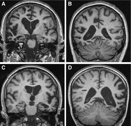 Representative brain imaging from patients with GRN mutations. (A) and (B) Coronal T1-weighted MR images showing asymmetrical right-sided fronto-temporo-parietal atrophy (Patient 7651_3)—4 years from symptom onset; (C) and (D) Coronal T1-weighted MR images showing asymmetrical left-sided fronto-temporo-parietal atrophy (Patient DRC431_3)—2 years from symptom onset.