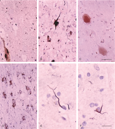 AGD, Gallyas silver staining, showing argyrophilic tangles (A, B), grains (A, B), neuropil threads (B) in the CA1 region (A) and entorhinal cortex (B), periventricular astrocytes (D), and oligodendroglial coiled bodies in the white matter of the temporal lobe (E, F). Ballooned neurons in the amygdala show a diffuse pale coloration (Gallyas negative). Sections lightly counterstained with haematoxylin. A–D, bar in C = 25 microns. E, F, bar in F = 10 microns.