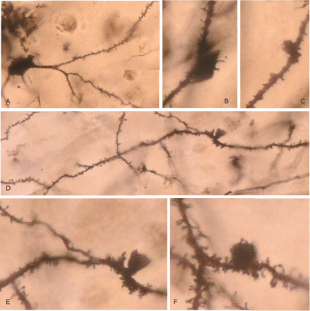 AGD, Rapid Golgi method. (A) Neuron of the entorhinal cortex showing the normal morphology of dendrites and dendritic spines. (B) Spindle-shaped and (C) Round protrusions in dendrites. (D) Basilar dendrite with inverse-cone morphology with normal-appearing proximal (right) and distal (left) processes. (E) High magnification showing the smooth surface of the protrusion and the normal morphology of the spines in the mother dendrite. (F) Round protrusion covered with a few dendritic spines in a normal-appearing dendrite filled with dendritic spines.