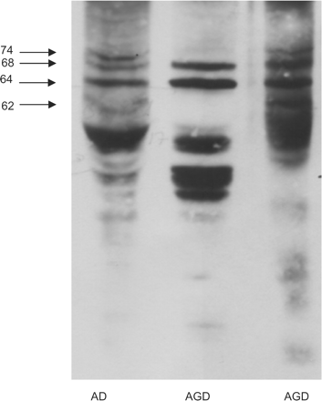 Gel electrophoresis and western blotting of sarkosyl-insoluble fractions of the hippocampus in one case with AD and one pure AGD processed in parallel. Four bands of 74, 68, 64 and 60/62 kDa are characteristic of AD. Two bands of 68 and 64 kDa are seen in AGD. In addition, several bands of lower molecular mass are found in AGD.