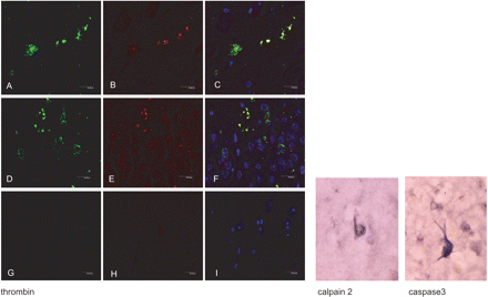 Left panel: Double-labelling immunofluorescence and confocal microscopy showing co-localization of thrombin (green: A, D) and 4R tau (red: B, E) in grains (yellow: C, F) in CA1 area of the hippocampus (A–C) and dentate gyrus (D–F). (G–H): sections incubated without the primary antibodies serve as negative controls. Dilution of the thrombin antibody (American Diagnostica) 1:100 and 4R tau (Upstate) 1:50, respectively. TO-PRO counterstaining (blue) permits the visualization of nuclei. Right panel: calpain 2 (Calbiochem) 1:25 and active caspase 3 (17 kDa) (Cell Signalling) 1:25 immunohistochemistry. Immunoreactivity is restricted to neurofibrillary tangles.