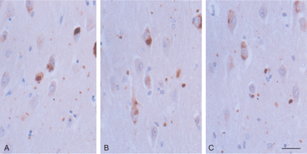 GSK-3 (A), SAPK/JNK-P (B) and p38-P (C) immunoreactivity in the CA1 region of the hippocampus in AGD. Active tau-kinases are expressed in pre-tangle neurons, tangles and grains. Paraffin section lightly counterstained with haematoxylin. Dilution of the antibodies p38-PThr180/Tyr182 (cell Signalling) 1:200; SAPK/JNK-PThr183/Tyr185 (Cell Signalling) 1:150, GSK-3β-PSer9 (Oncogen) 1:150. Bar = 25 microns.