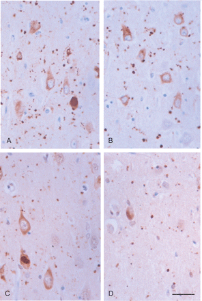 p62 immunoreactivity (A, B) is found in pre-tangle neurons, tangles and grains in the CA1 region of two different AGD cases. Ubiquitin immunoreactivity (C, D) is also observed in pre-tangle neurons, tangles and grains in the same cases. Paraffin section lightly counterstained with haematoxylin. Dilution of anti-p62 C-terminal antibody (Progen) 1:100 and anti-ubiquitin (Dako) 1:500. Bar = 25 microns.
