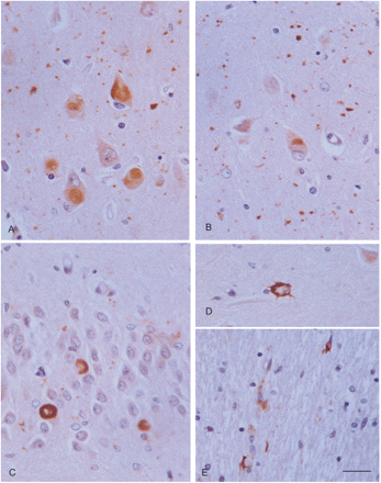 Round elongated deposits of mutant ubiquitin (UBB+1) immunoreactivity in neurons of the CA1 region (A), entorhinal cortex (B), and granule cells of the dentate gyrus (C), as well as in astrocytes (D) and coiled bodies (E). UBB+1 immunoreactivity is clearly present in grains (A, B). Paraffin section lightly counterstained with haematoxylin. Dilution of the rabbit polyclonal UBB+1antibody (Dr Fred W. van Leeuwen, Ubi2+1, 140994, for details see Fisher et al., 2003) 1:400. A, B, bar in B = 25 microns; C–E, bar in E = 10 microns.
