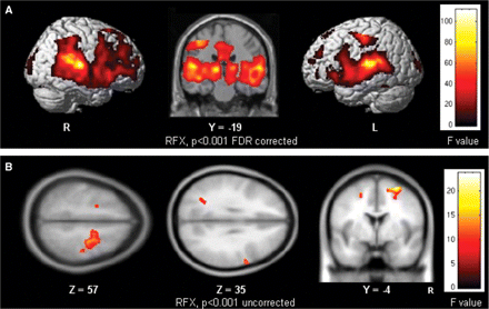 (A) Group activation map showing brain regions activated on average over all subjects (N = 24; Control + ASC) by processing Novel target sounds compared with Standard sounds. Voxels with activation significant at P < 0.001 (F = 9.62), FDR corrected for multiple comparisons are shown; R = right hemisphere; L = left hemisphere and (B) Group difference map showing brain regions differentially activated between groups (Control < ASC; N = 12 in each group) by processing of Novel target sounds compared with Standard sounds. Voxels with activation significant at P < 0.001 (F = 8.12) are shown.