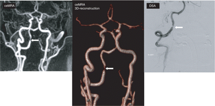 Contrast enhanced MRA and digital subtraction angiography showing tight stenosis of the right distal vertebral artery (arrow) and occlusion of left vertebral artery.