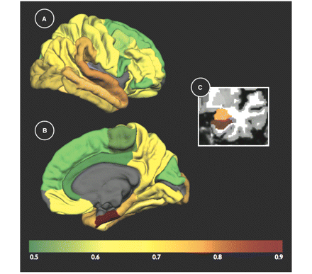AUC results (neocortical thickness and non-neocortical volumes) from the first regression model (MCI versus older controls) for all of the automated ROIs from the training cohort (OASIS subjects) displayed on the grey matter surface (only one hemisphere is shown) in (A) lateral, (B) medial views and (C) the two non-neocortical regions (i.e. the hippocampus and amygdala) in the coronal view of a T1-weighted MRI image. The colour scale at the bottom represents the discrimination accuracy (AUC value), with green indicating regions of lowest discrimination and brown/red indicating regions of highest discrimination (please see text for specific AUC values for each ROI).