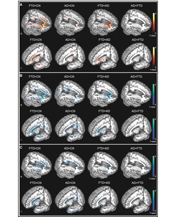 Rendered display of DTI changes (A) reduced FA (warm colours); (B) increased Dra (cool colours); (C) increased Dax (cool colours) in FTD or Alzheimer's disease compared with cognitively normal subjects, as well as direct comparisons between FTD and Alzheimer's disease.