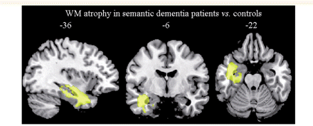 The pattern of white matter atrophy in patients with semantic dementia compared with 48 age-matched healthy controls (P < 0.05, corrected at the cluster level). Regions are superimposed on the MNI standard brain in neurological convention (right is right) WM = white matter.