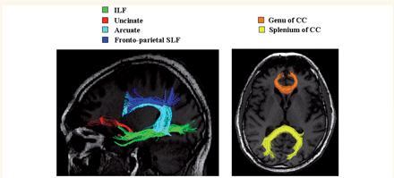 Reconstructions of white matter tracts in a single healthy control: the left ILF in green, the left uncinate fasciculus in red, the left arcuate fasciculus in cyan, the left fronto-parietal SLF in blue, the genu of the corpus callosum in orange and the splenium of the corpus callosum in yellow. Tracts are superimposed onto the subject's T1-weighted image normalized into the FA space. CC = corpus callosum