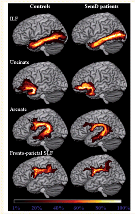 Group probabilistic maps of the language-related white matter tracts from healthy controls and semantic dementia (SemD) patients. Left ILF, uncinate fasciculus, arcuate fasciculus and fronto-parietal SLF are superimposed on the three-dimensional rendering of the MNI standard brain. The colour scale indicates the degree of overlap among subjects.