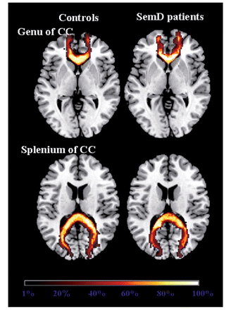 Group probabilistic maps of the genu and splenium of the corpus callosum from healthy controls and semantic dementia (SemD) patients are shown on the axial sections of the MNI standard brain. The colour scale indicates the degree of overlap among subjects.
