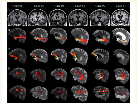 (A) Structural MRI of one representative control and each semantic dementia patient (coronal view). (B–D) Left language-related white matter tracts are rendered as maps of MD in one representative control and all patients (B: ILF; C: uncinate fasciculus; D: arcuate fasciculus; E: fronto-parietal SLF). The colour scale represents the MD values going from lower (dark red) to higher values (yellow to white). Maximum damage is present in the anterior portion of the ILF and uncinate fasciculus underlying the temporal pole.